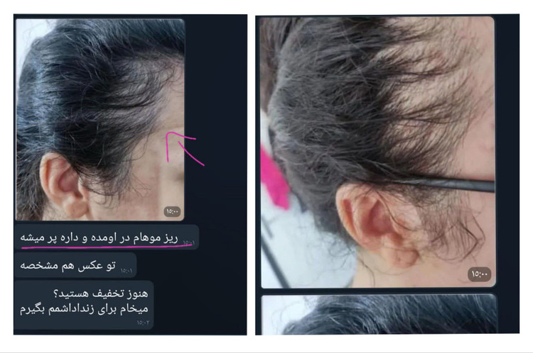 دوره رویش مجدد مو و ریش 🧔🏻♀️