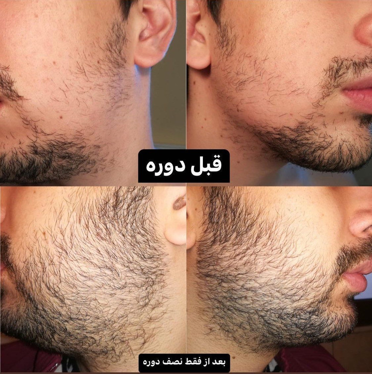 دوره رویش مجدد مو و ریش 🧔🏻♀️